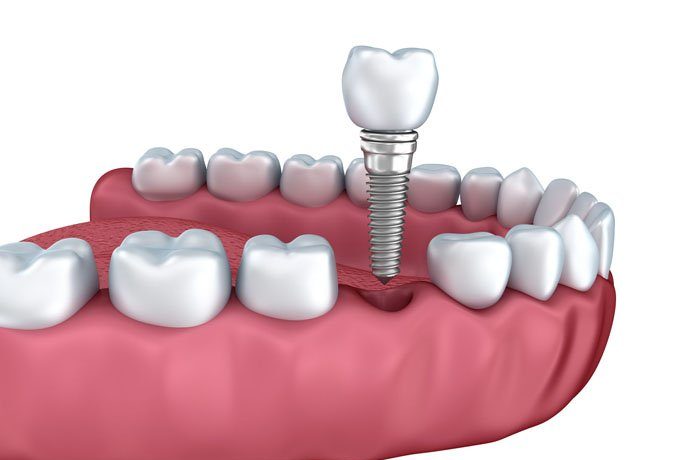 What is a dental crown and what are its prices?