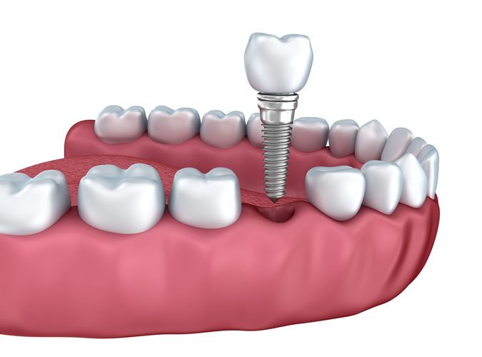 What is a dental crown and what are its prices?